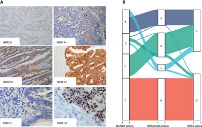 Human Epidermal Growth Factor Receptor 2 Overexpression and Amplification in Patients With Colorectal Cancer: A Large-Scale Retrospective Study in Chinese Population